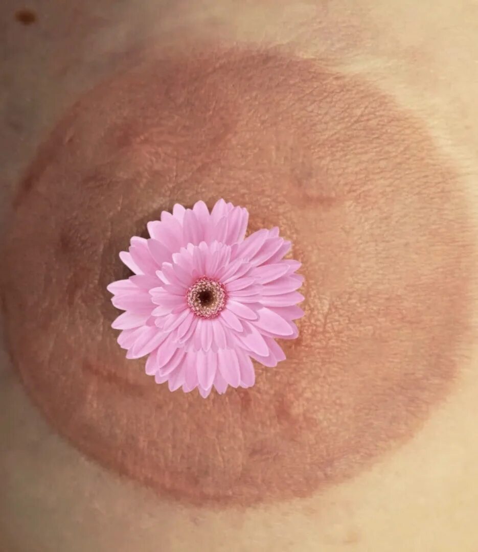 Эстрадиоловая гинекомастия. Большие ореолы. Ореолы сосков девушек. Ореолы сосков девушек. Коричневые соски мужские.