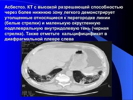 Асбестоз
