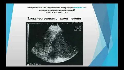 Болит печень гемангиома