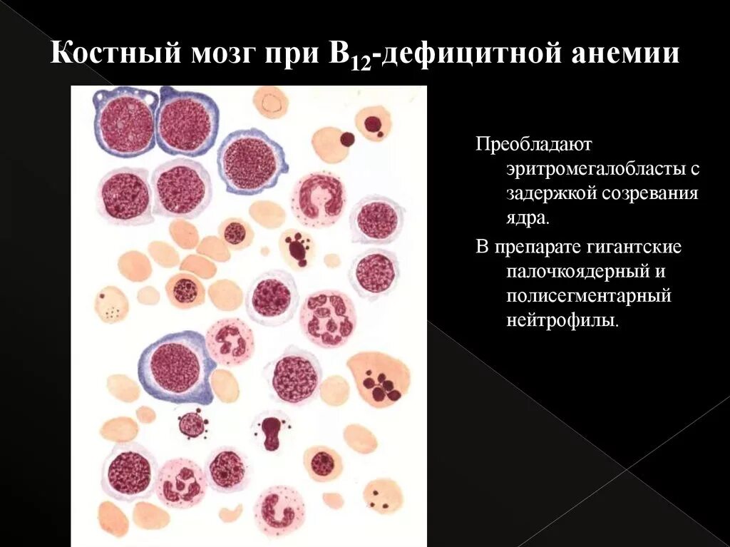 В12 при железодефицитной анемии. В12 дефицитная анемия костный мозг. Костный мозг при в12 дефицитной. Стернальная пункция при в12 дефицитной анемии. Картина костного мозга при в12 дефицитной анемии.