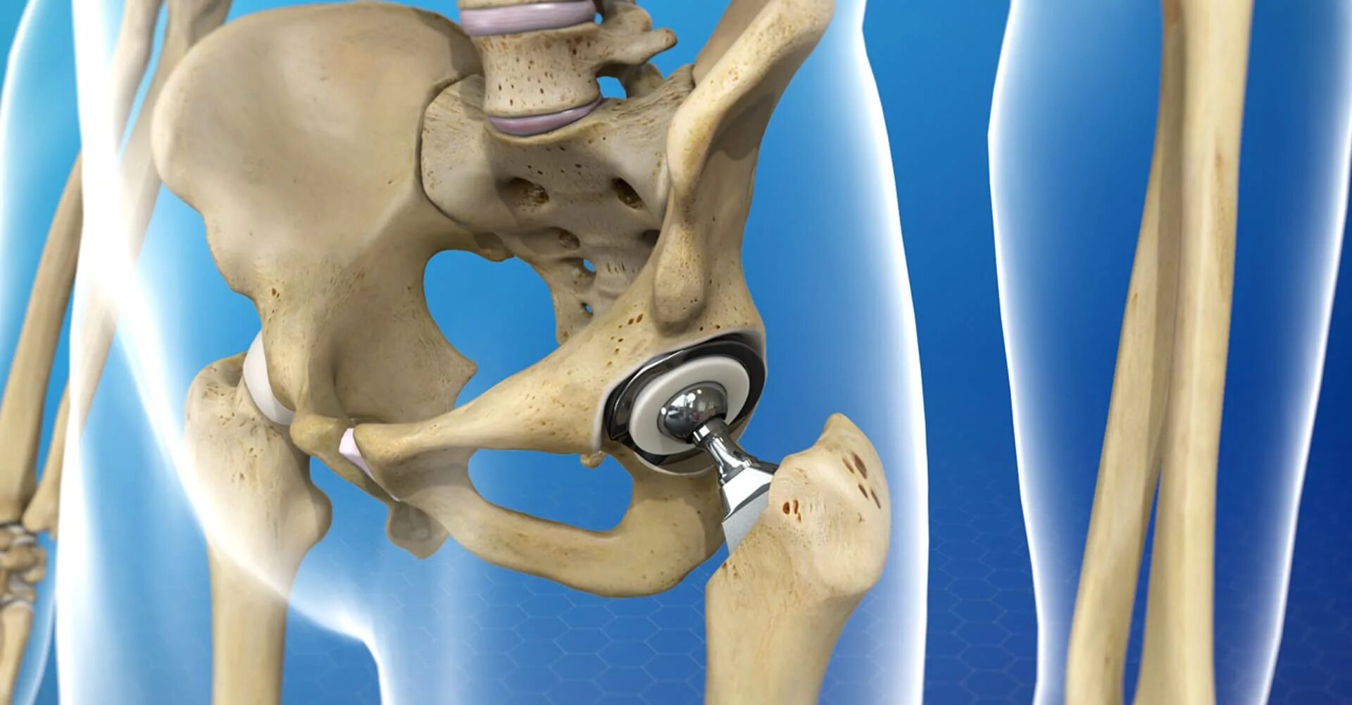 Тотальное эндопротезирование коленного сустава. Эндопротезирование тазобедренного сустава 3 д. Эндопротез коленного сустава columbus. Коленный эндопротез зиммер. Зиммер протезы для тазобедренных суставов.