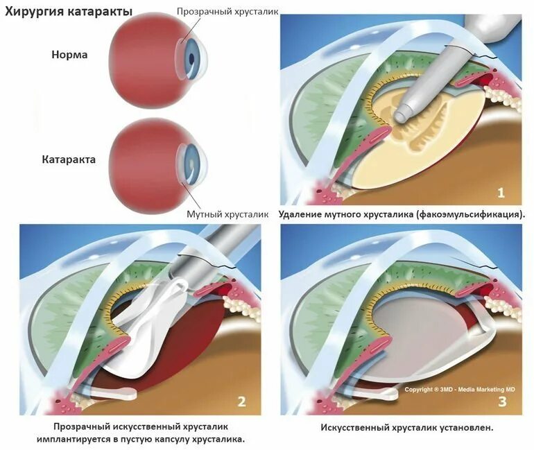 Операция катаракты сколько по времени. Катаракта факоэмульсификация. Интраокулярная экстракция катаракты. Катаракта операция схема. Интракапсулярная экстракция катаракты.