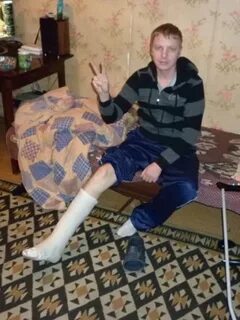 Человек сломал ногу
