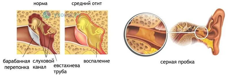 Тубоотит барабанная перепонка. Наружный отит серная пробка. Серные пробки в евстахиевой трубе. Что делать если в ухе застряла вода