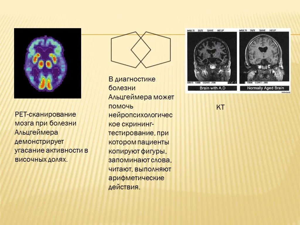 Болезнь заболевание мозга. Выявления болезни Альцгеймера. Мозг при болезни Альцгеймера. ПЭТ сканирование мозга. Болезнь Альцгеймера и пика.