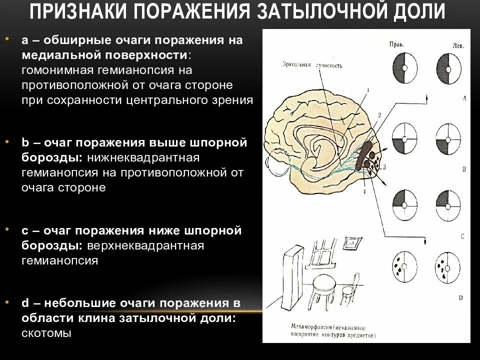 Поражение затылочной доли головного мозга симптомы. Симптомы поражения затылочной доли неврология. Повреждение затылочной доли головного мозга. Синдромы поражения отдельных лобных долей. Синдромы поражения коры