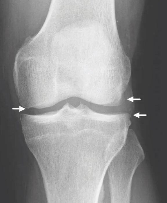 Остеоартроз 1 2 степени коленного сустава. Гонартроз коленного сустава 1 степени на рентгене. Гонартроз 1 степени на рентгене. Деформирующий артроз коленного сустава рентген. Остеоартроз коленного сустава степени рентген.