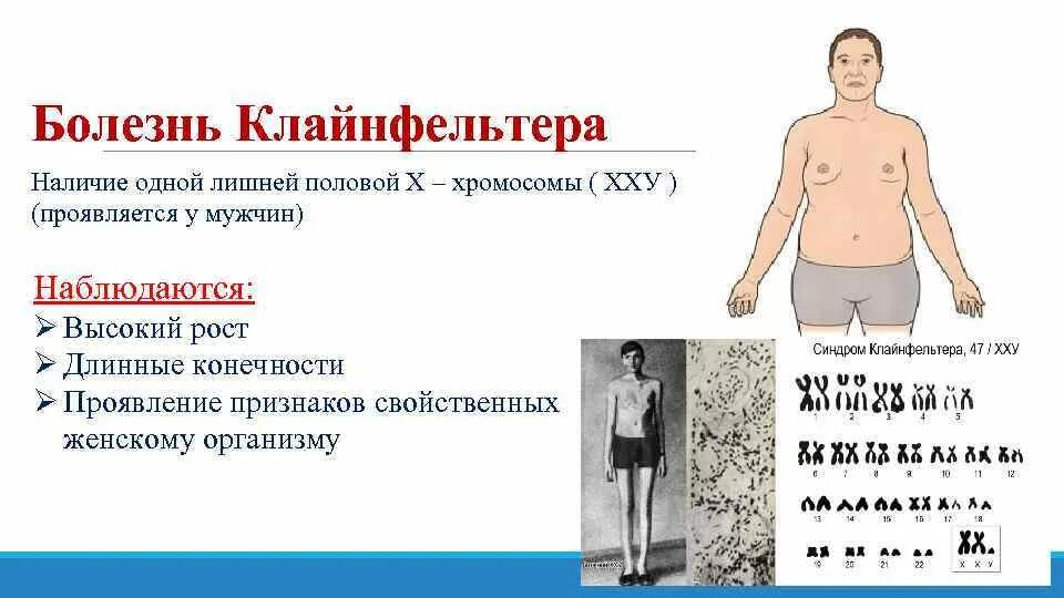 Синдром клайнфельтера евнухоидное. Метод определения синдрома клайнфельтера. Метод выявления синдрома клайнфельтера. Синдром кляйн фельтера. Синдром клайнфельтера симптомы.