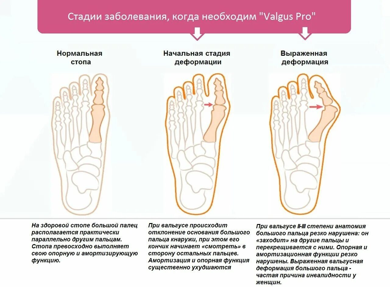 Нарушения стопы. Вальгусное отклонение первого пальца стопы у ребенка. классификация вальгусной деформации 1 пальца стопы. вальгусная деформация первого пальца схема операции. степени вальгусной деформации 1 пальца стопы.