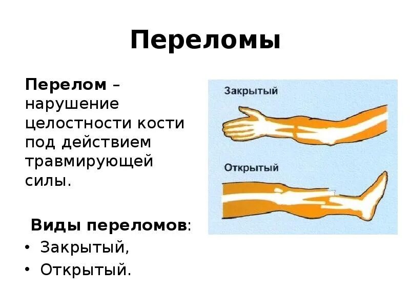 Степени открытого перелома. Классификация переломов костей конечностей. Классификация открытых и закрытых переломов. Переломы длинных трубчатых костей. Краткое понятие открытый и закрытый перелом.