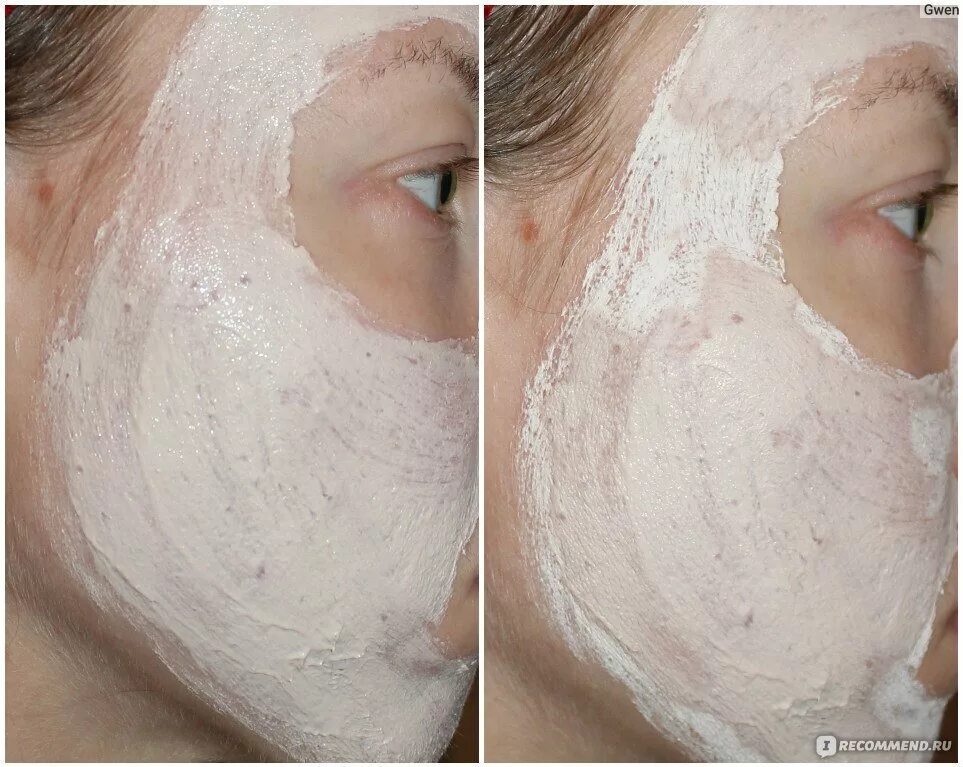 Сухая кожа эффективная маска. Маска от прыщей. маска для угреватой кожи. маска от избавления прыщей.