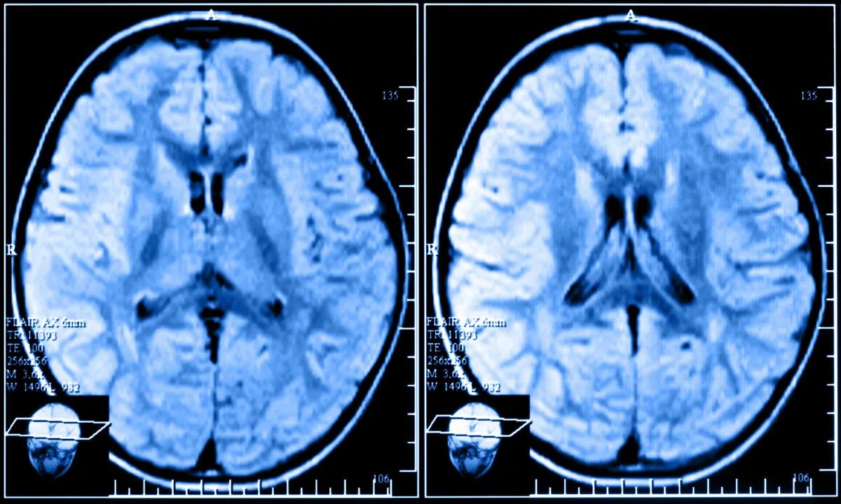 Атрофия мозга лечение. Атрофические изменения головного мозга мрт. Атрофические изменения головного мозга кт. Атрофия мозжечка кт мрт. Мультисистемная атрофия головного мозга на мрт.