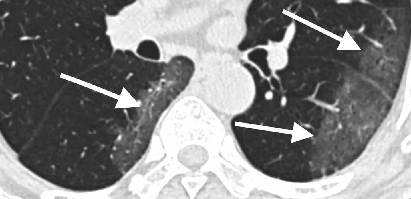 Кт 4 легкие. Коронавирусная пневмония на кт. Кт-4 пневмония ковидная. Ковид пневмония кт. Пневмония на кт.