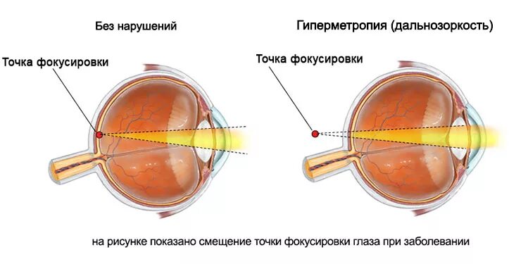 Болезнь дальнозоркость. Миопия схема глаза. Заболевание органов зрения миопия. Нарушение зрения астигматизм. Близорукость и дальнозоркость схема глаза.