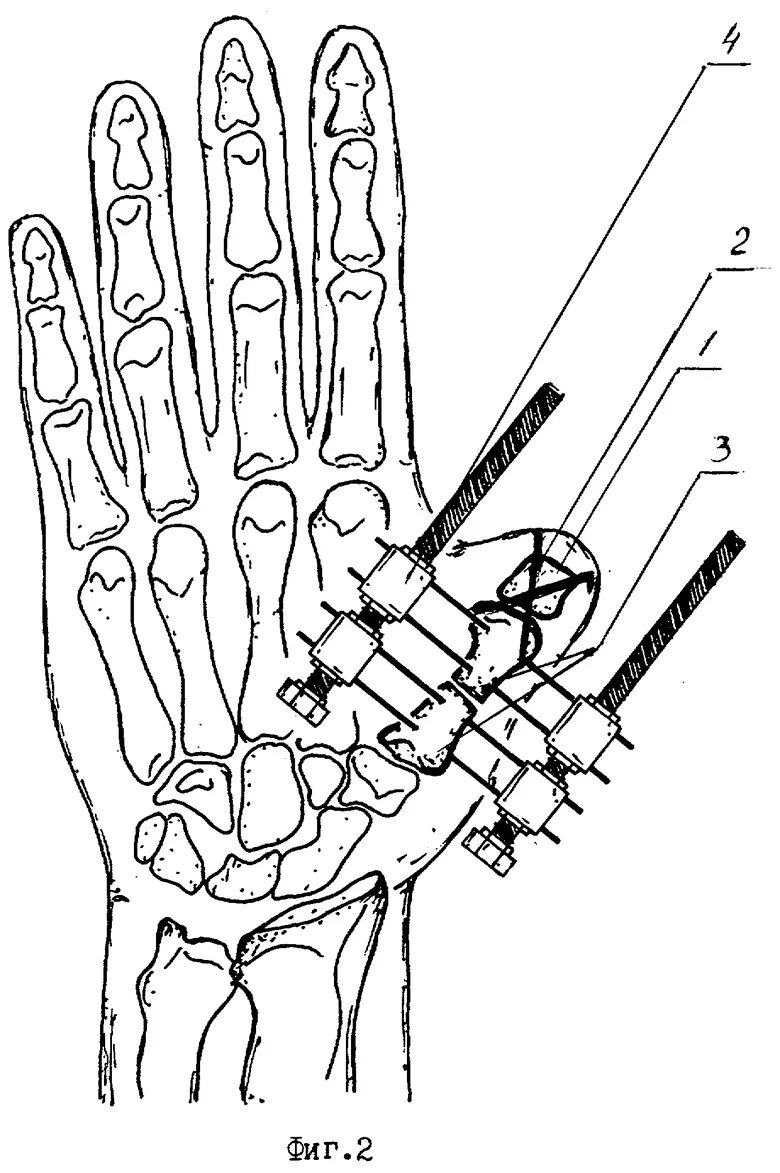 Операция пястной кости. Остеосинтез 3 пястной кости. Остеосинтез 1 пястной кости кисти. Операция на пястной кости. Фиксатор 1 пястной кости большого пальца.