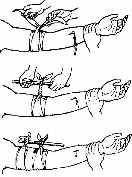 Артериальное кровотечение бинтование. Наложение жгута при венозном кровотечении. Перевязывание руки при артериальном кровотечении. Венозное кровотечение перевязка.