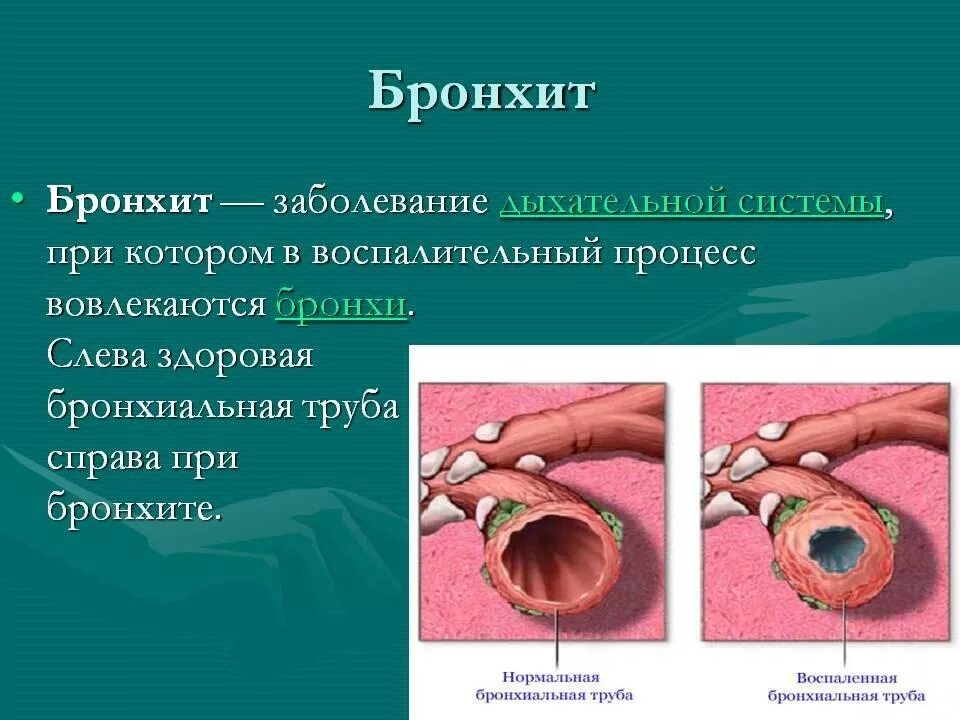 Как понять что бронхит прошел. Симптомы поражения бронхов. поражение бронхов острый бронхит. бранхии. бронекит.