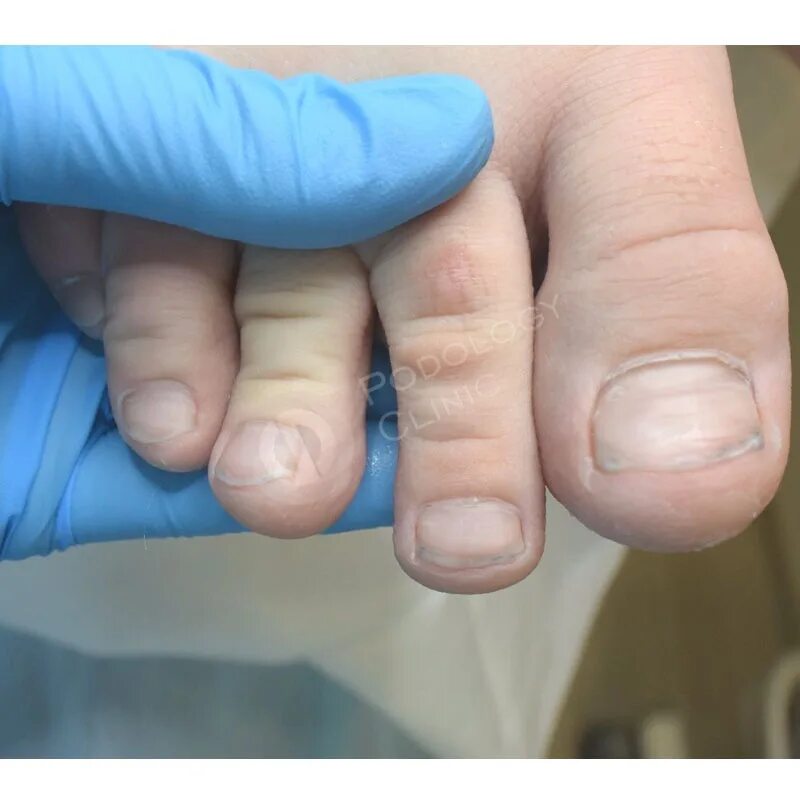 Гипергидроз пальцев рук. Гипергидроз пальцев рук у ребенка. Гипергидроз между пальцами ног.