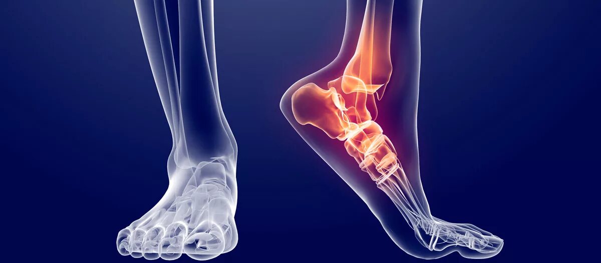 артроз пяточного сустава. артроз таранно пяточного сочленения. артроз таранно-ладьевидного сустава. таранно-ладьевидный артроз 3 степени. травма костей голеностопа.