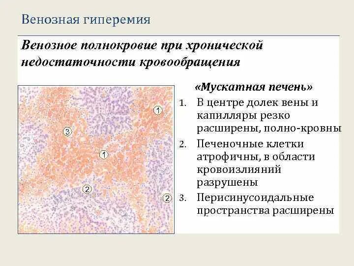 Хроническое полнокровие печени. Макропрепарат печень при хроническом венозном полнокровии мускатная. Хроническое венозное полнокровие печени микропрепарат рисунок. Полнокровие патанатомия. Острое венозное полнокровие патанатомия.