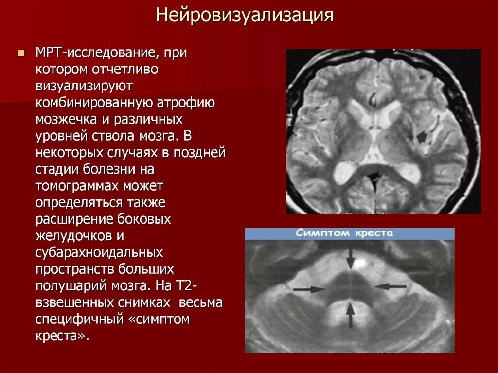 Атрофия полушарий. Кт и мрт Нейровизуализация. Мозжечковая атаксия кт признаки. Мозжечковая дегенерация мрт. Атрофия червя мозжечка кт.