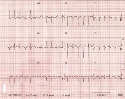 Тахикардия qrs