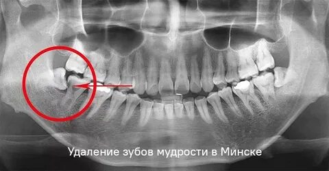 Зачаток восьмерки