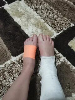 Лечение без гипса