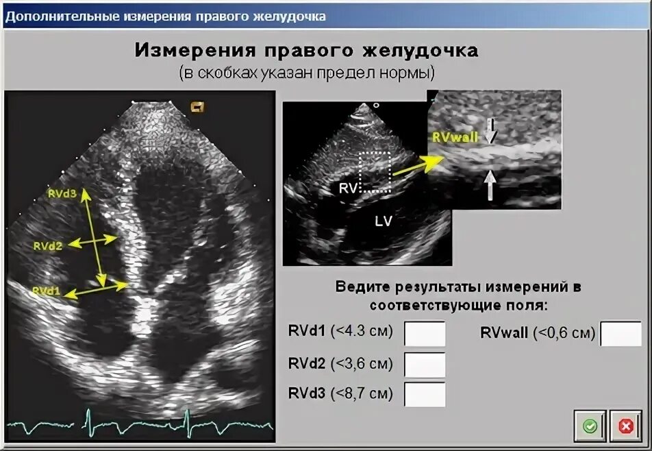 Правый желудочек размеры. Измерение правого желудочка на ЭХОКГ. Измерение tapse правого желудочка. Правый желудочек ЭХОКГ. Измерения левого желудочка.