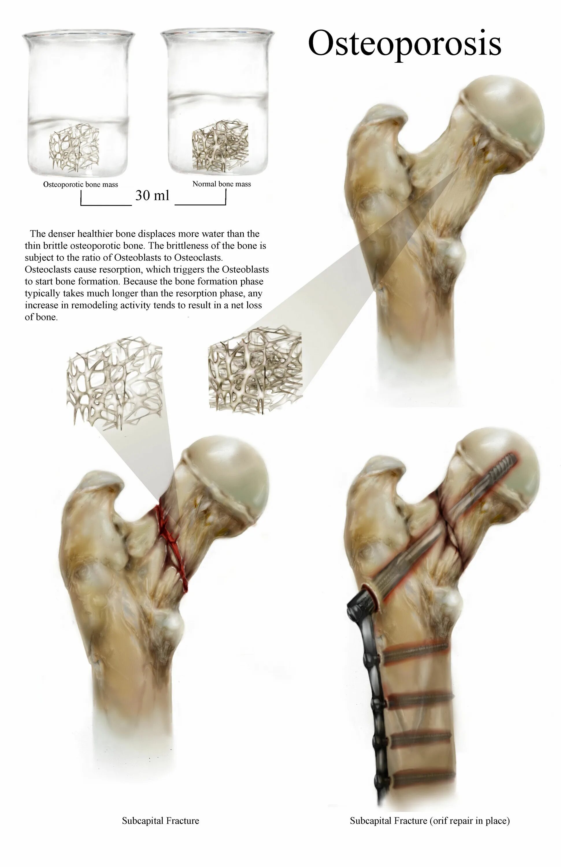 Osteoporotic Bone. Major osteoporotic Fracture перевод.