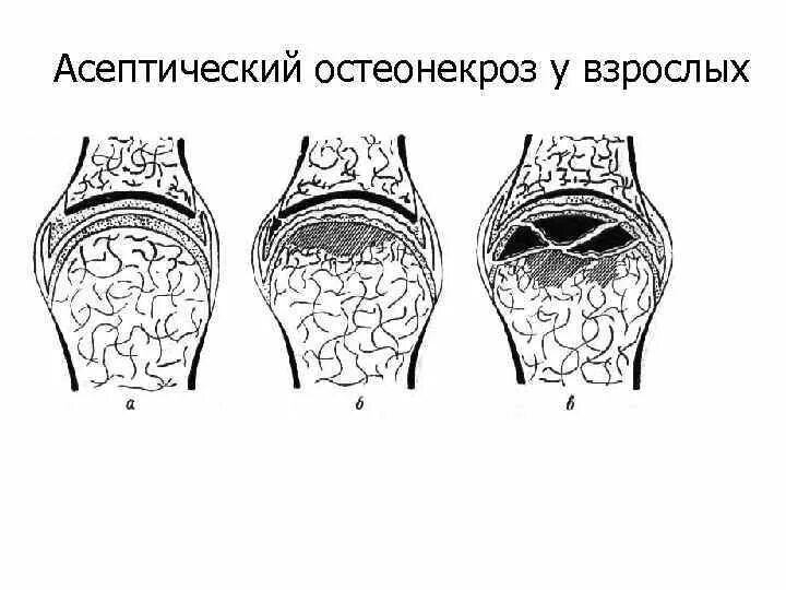 Некроз мыщелка бедренной. Асептический некроз большеберцовой кости кт. Остеонекроз мыщелка бедренной кости. Асептический некроз мыщелка бедренной кости. Асептический некроз коленного сустава.