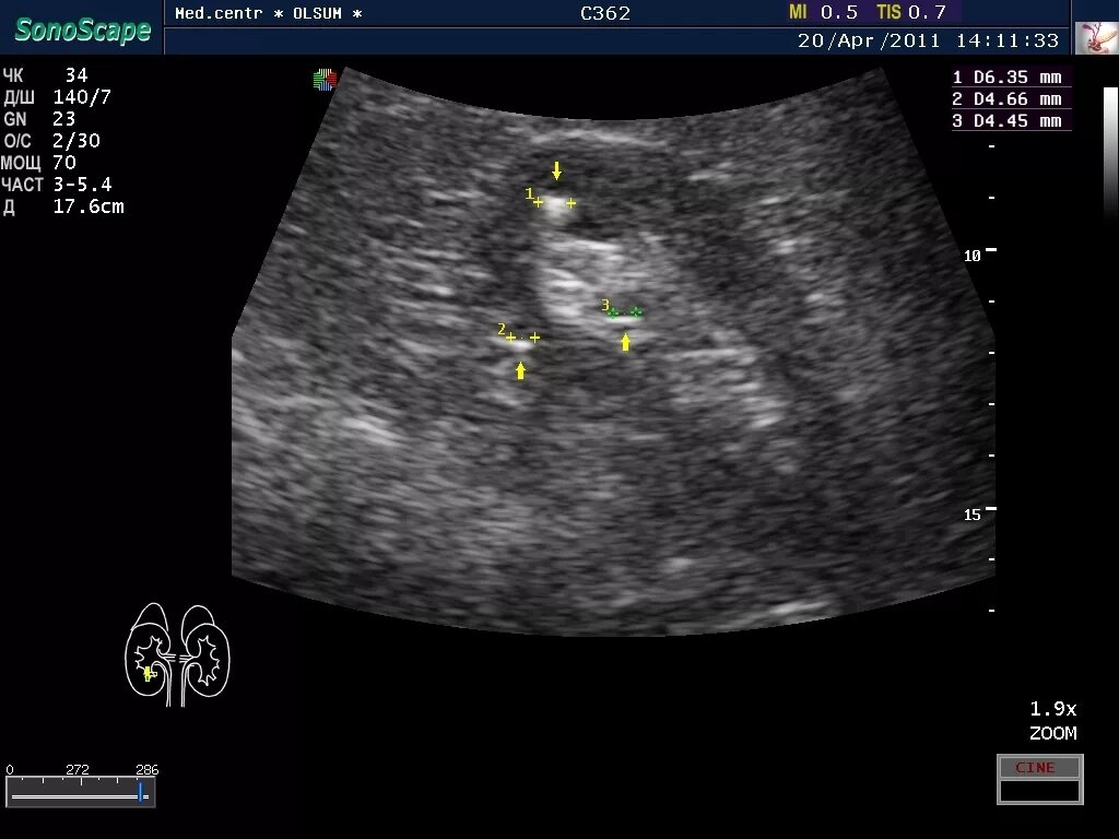 Кальцинат в правой доле. Микрокальцинаты в почках на УЗИ. Кальцинаты в паренхиме почки УЗИ. Кальцинат паренхимы почки на УЗИ. Солевое отложение в почке на УЗИ.
