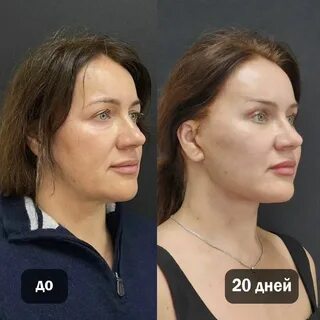 Маммопластика до и после