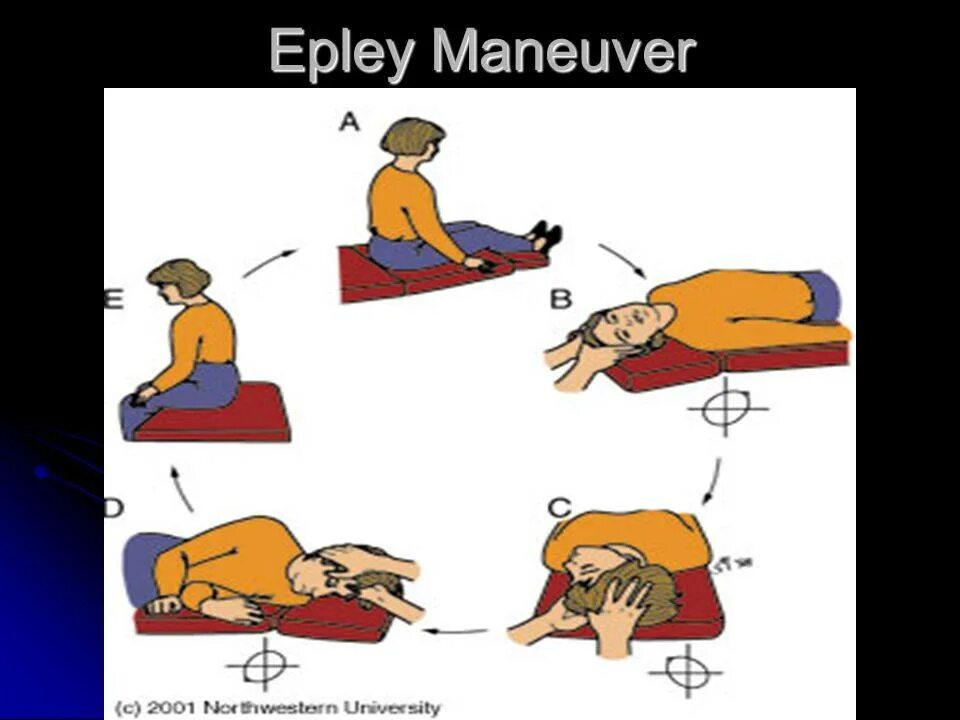 Упражнения брандта при головокружении. Маневры Эпли при головокружении. Упражнение Эпли при головокружении. Методика Эппле при головокружении. Метод Брандта-Дароффа.