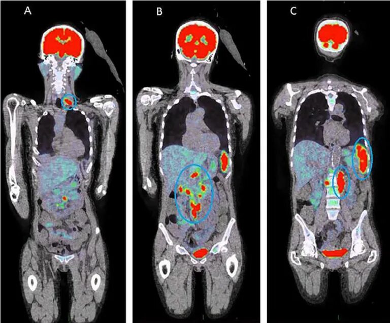 Pet ct. Позитрон-эмиссионная  томография: ПЭТ. Позитронно-эмиссионная трансаксиальная томография. ПЭТ кт с контрастированием. ПЭТ кт снимки метастазы.