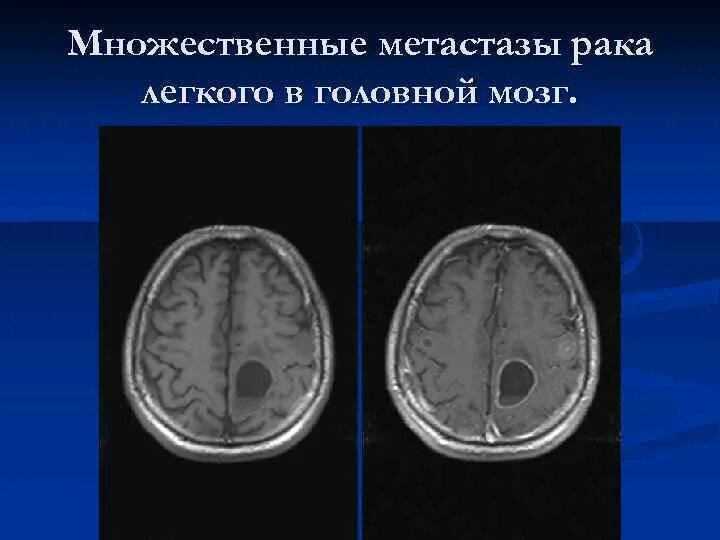 Лечение метастазов мозга. Метастатические опухоли головного мозга. Метастазы головного мозга кт. Метастазы головного мозга мрт. Мрт головного мозга при метастазах.