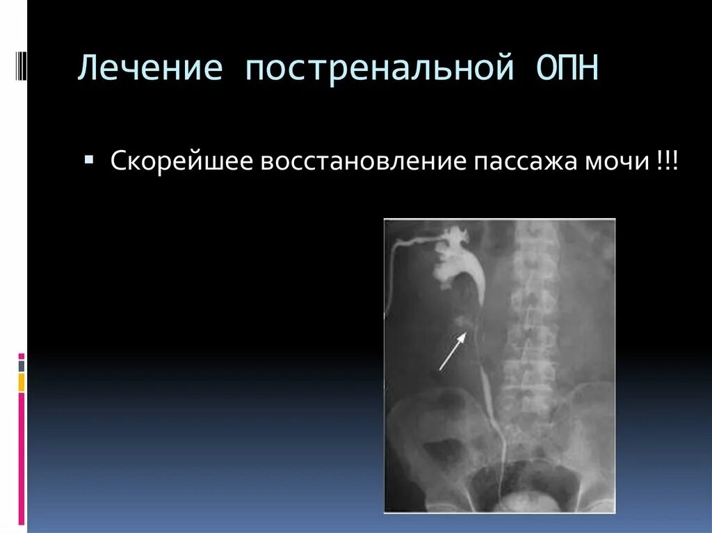 Пассаж мочи. Постренальная почечная недостаточность. Постренальная форма ОПН. Постренальная ОПН лечение. Лечение постренальной ОПП.