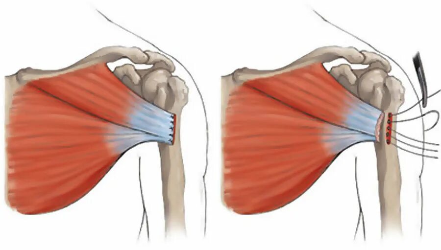 Лечение частичного разрыва мышц. Отрыв сухожилия грудной мышцы. Реинсерция сухожилия большой грудной мышцы. Разрыв сухожилия большой грудной мышцы. Разрыв сухожилия ключичной части большой грудной мышцы.