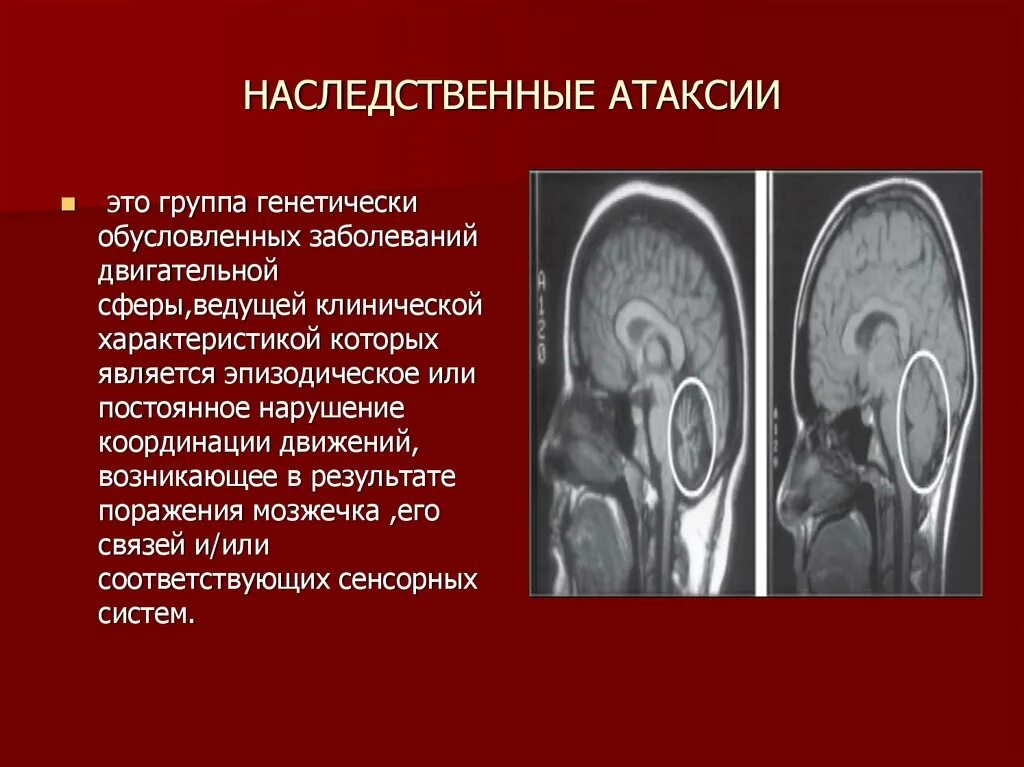 Атаксия Пьера Мари неврология. Мозжечковая атаксия генетическая. Наследственные спиноцеребеллярные атаксии. Наследственная атаксия