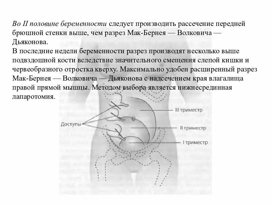 Острый аппендицит у беременных. Разрез по Волковичу Дьяконову при аппендиците у беременных. Волковича Дьяконова Мак Бурнея аппендэктомия. Разрез Волковича-Дьяконова.