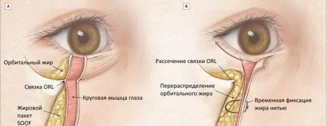 Блефаропластика синяки под глазами. Периорбитальная область вокруг глаз. Кожа вокруг глаз. Мешки под глазами жировые грыжи. Мешки на нижнем веке.