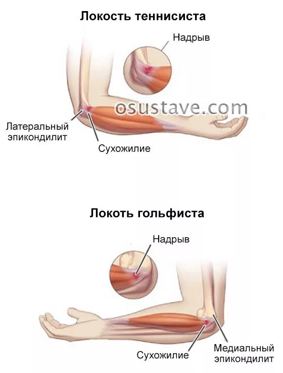 Почему болят локтевые сгибы. Локоть теннисиста латеральный эпикондилит. Локоть теннисиста локоть гольфиста. Эпикондилит локтевого сустава на УЗИ. Заболевание локтевого сустава локоть теннисиста.