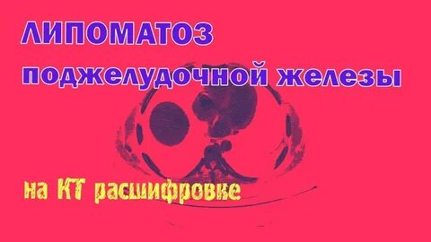 Что такое липоматоз поджелудочной железы 1 степени