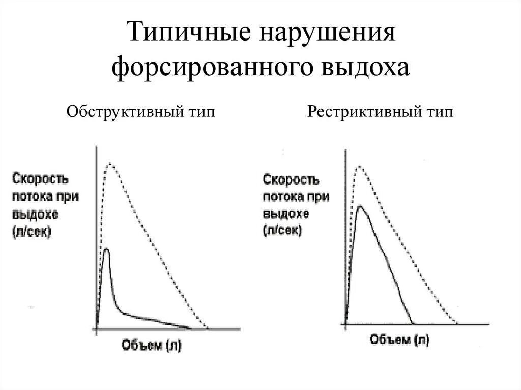 Обструктивный Тип нарушения функции внешнего дыхания. Обструктивный Тип нарушения дыхания спирометрия. Рестриктивный Тип ФВД. Спирография рестриктивный Тип. Нарушение легких по обструктивному типу