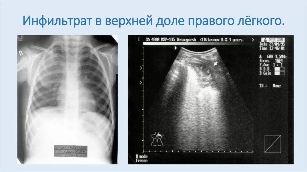 Фиброз нижних долей легких. Инфильтрация верхней доли правого легкого. Инфильтрация верхней доли легкого. Инфильтрат в правого лёгкого. Ультразвуковое исследование лёгких.