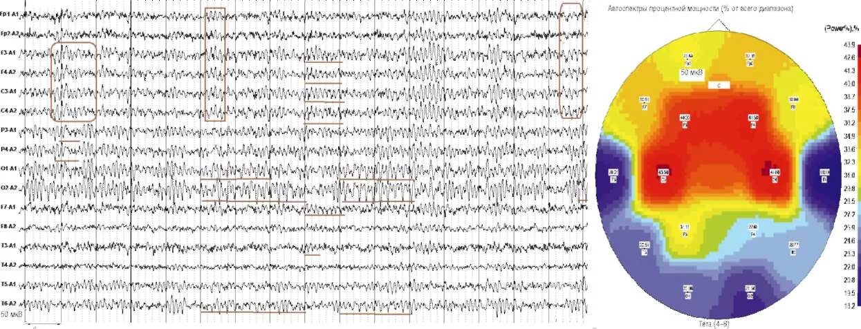 Ээг 2 часа. Затылочное ЭЭГ. ЭЭГ затылочного отдела. Затылочные электроды ЭЭГ. Тета волны на ЭЭГ У взрослого.