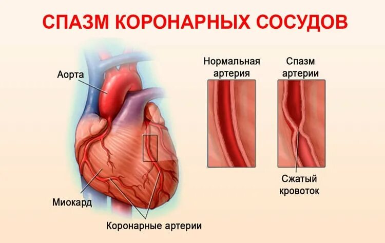 Спазм венечных артерий. Спазмы коронарных сосудов. Спазма коронарных артерий. Вазоспазм коронарных артерий.