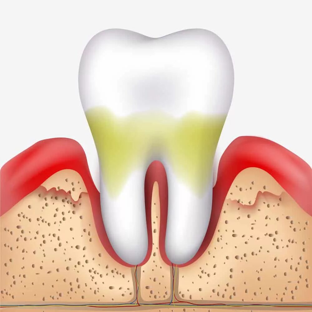 Периодонтит десневой карман. Межкорневой периодонтит. Периодонтит корня зуба. Осложнение лечения периодонтита