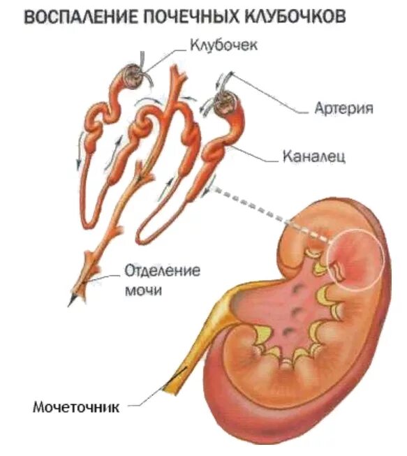 Гломерулонефрит воспаление клубочков почки. Клубочек почки при гломерулонефрит. Гломерулонефрит клубочковый нефрит. Поражение клубочков почек