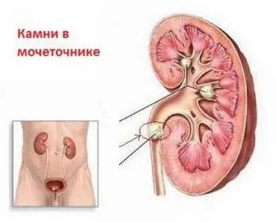 Дробление камня в мочевом